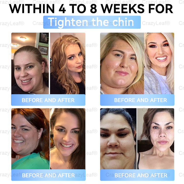 FDA Store🏥| 𝐵uil𝗱𝐿ea𝐟® 𝑺𝑀𝗚T-𝑮𝐋𝑃-1 𝐒limming & 𝐻ealth 𝑁ano 𝑀icroneedle 𝑃atch with Collagen & Matrixyl 3000 丨Obesity,Cardiovascular Diseas, Diabetes, Sleep Apnea, Joint Problems and More