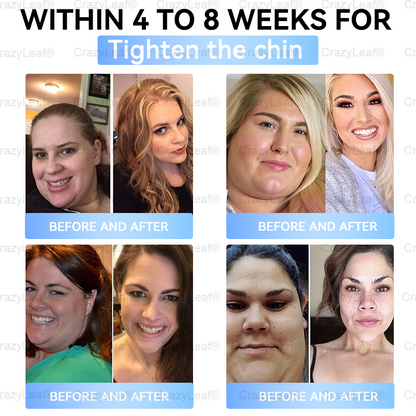 FDA Store🏥| 𝐵uil𝗱𝐿ea𝐟® 𝑺𝑀𝗚T-𝑮𝐋𝑃-1 𝐒limming & 𝐻ealth 𝑁ano 𝑀icroneedle 𝑃atch with Collagen & Matrixyl 3000 丨Obesity,Cardiovascular Diseas, Diabetes, Sleep Apnea, Joint Problems and More