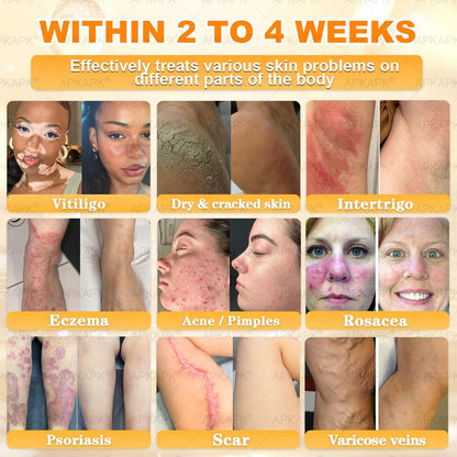 Made and Shipped from USA ✨𝖠𝖯𝖪𝖠𝖯𝖪® 𝖡𝖾𝖾 𝗏𝖾𝗇𝗈𝗆 𝖲𝗄𝗂𝗇 𝖱𝖾𝗌𝗍𝗈𝗋𝖺𝗍𝗂𝗈𝗇 𝖢𝗋𝖾𝖺𝗆 ✨