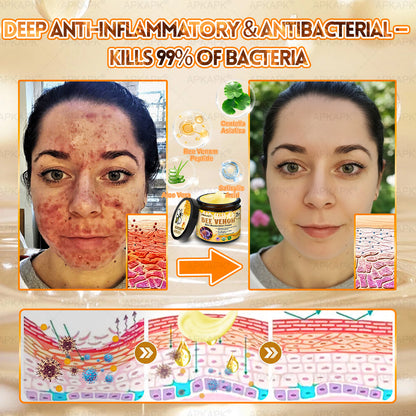 Made and Shipped from USA ✨𝖠𝖯𝖪𝖠𝖯𝖪® 𝖡𝖾𝖾 𝗏𝖾𝗇𝗈𝗆 𝖲𝗄𝗂𝗇 𝖱𝖾𝗌𝗍𝗈𝗋𝖺𝗍𝗂𝗈𝗇 𝖢𝗋𝖾𝖺𝗆 ✨